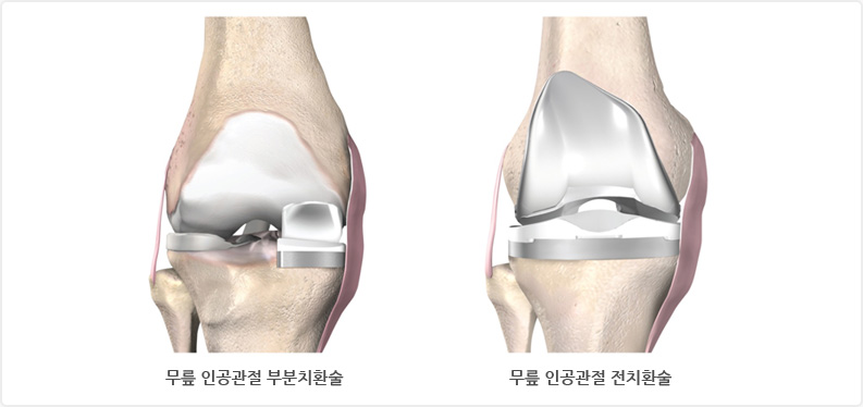 왼쪽사진 - 무릎 인공관절 부분치환술, 오른쪽 사진 - 무릎 인공관절 전치환술