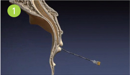경추-요추 신경성형술 총 4단계중 첫번째 단계 사진