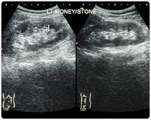 초음파 (ultrasonography)